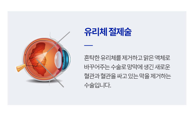 유리체 절제술